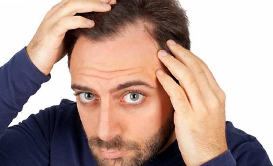Τριχόπτωση: Γιατί 1 στους 2 άντρες πάσχουν από ανδρογενετική αλωπεκία;