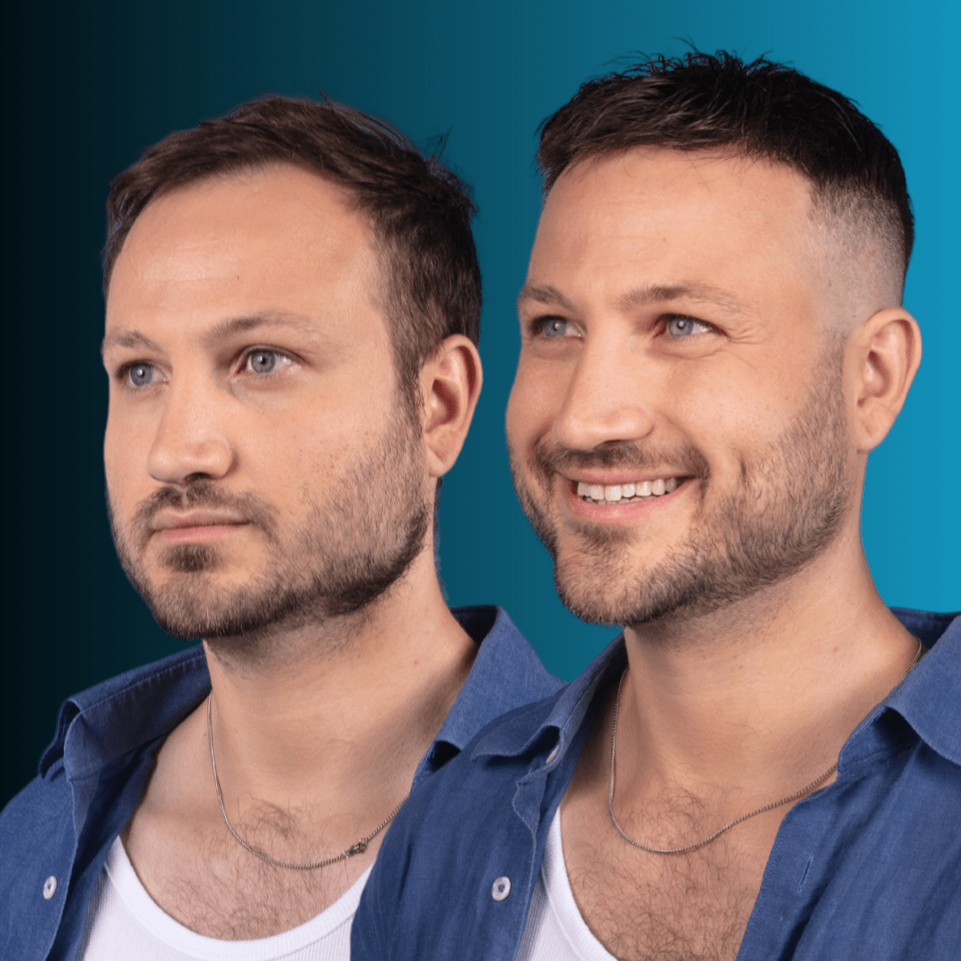 Σύστημα Μαλλιών MACOhair® MACO HAIR SYSTEMS