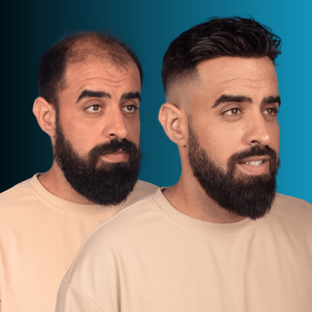 Σύστημα Μαλλιών MACOhair® MACO HAIR SYSTEMS