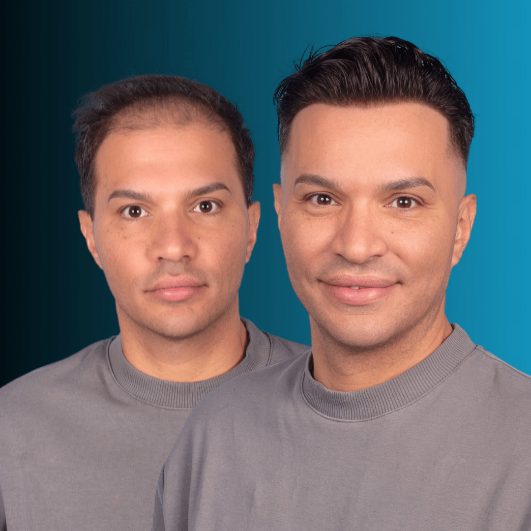 Σύστημα Μαλλιών MACOhair® MACO HAIR SYSTEMS